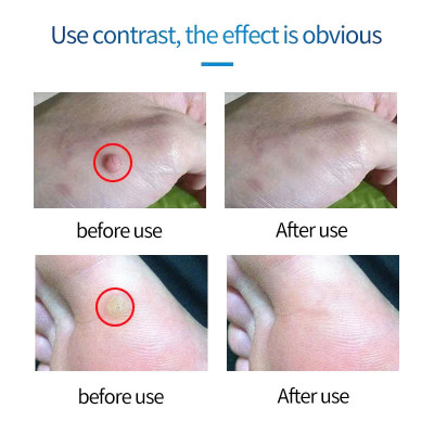 Kem Trị Mụn Cóc, Mụn Thịt, Mụn Cơm Hiệu Quả Sau 7 Ngày – Chiết Xuất Thảo Dược An Toàn 20g