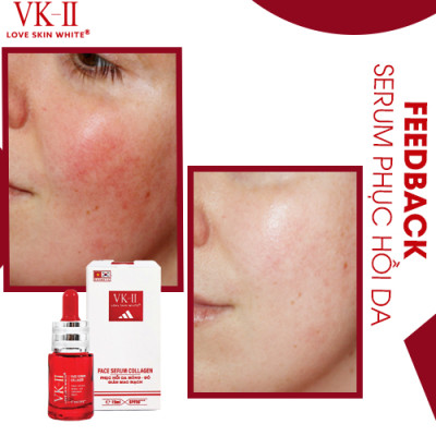Tinh chất dưỡng phục hồi da mỏng đỏ, dị ứng VK-II Love Skin White Face Serum Collagen 15ml