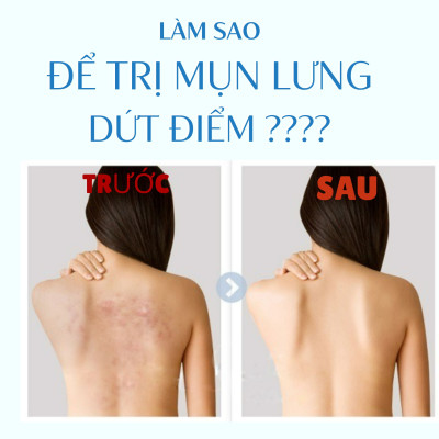 Xà Phòng Tắm Ngừa Mụn Vùng Lưng Pelican For Back Soap Bar (135 G)